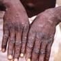 <p>Monkeypox Outbreaks In Africa</p>