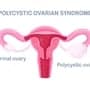 pcos symptoms and treatment